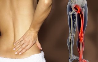 Preventing Sciatica